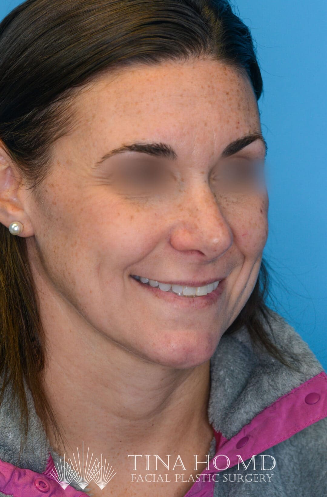 Patient ML's improved second right oblique view after rhinoplasty