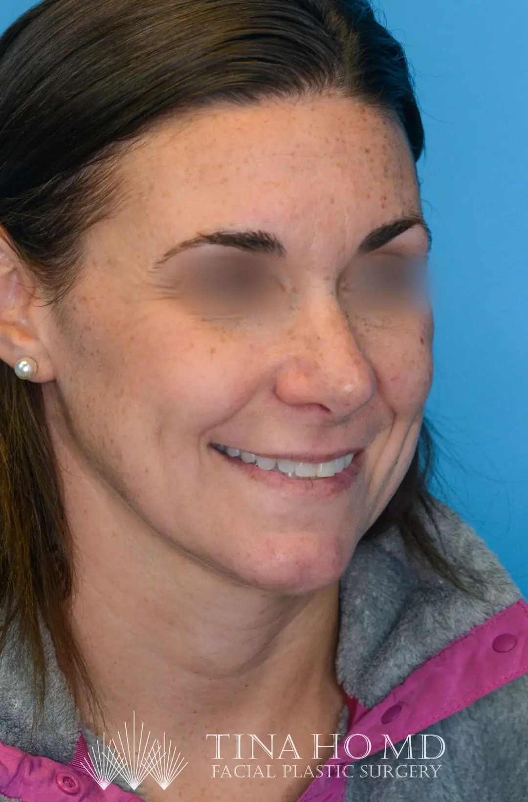Patient ML's improved second right oblique view after rhinoplasty