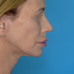 MMrightlateral(web) copy