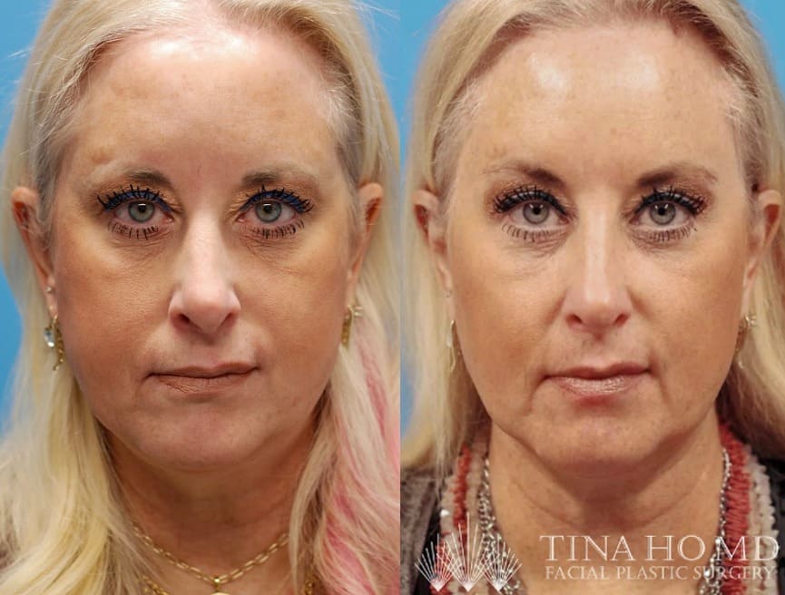 Woman shows facial rejuvenation results after Philadelphia brow lift surgery.