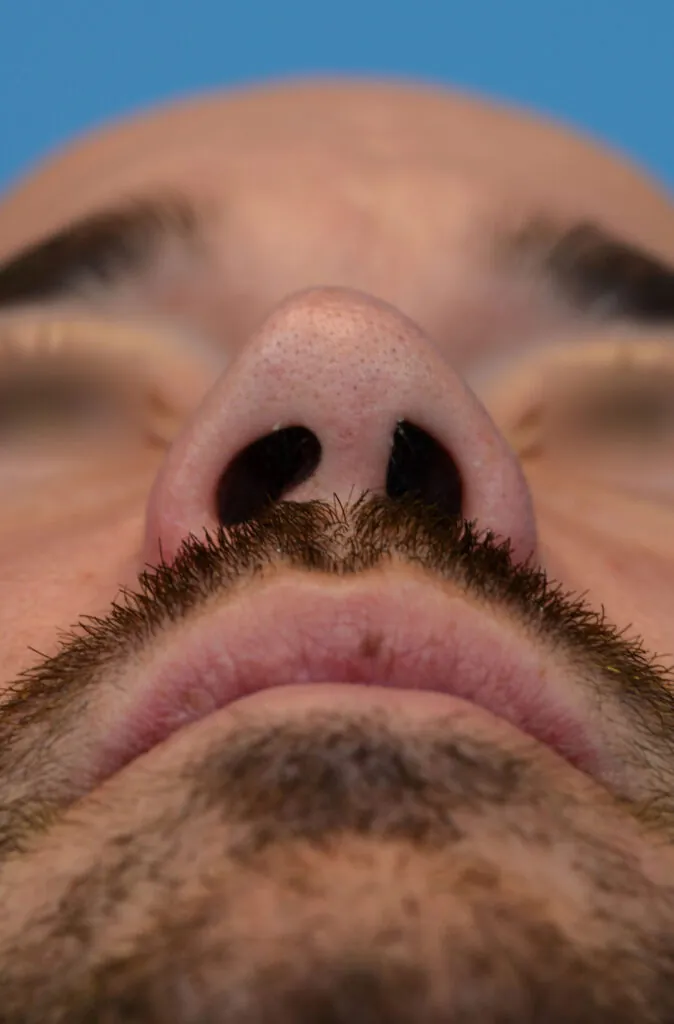 Patient DN's basal view before rhinoplasty surgery