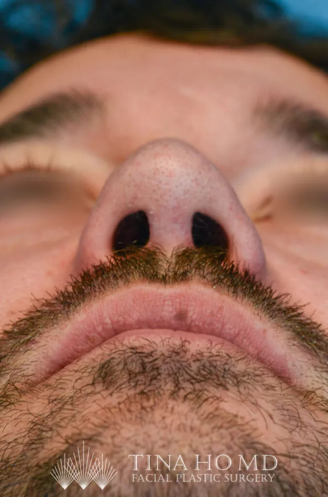 Patient DN's improved basal view after rhinoplasty surgery