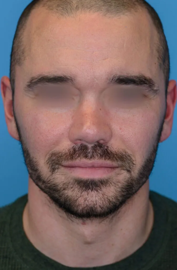 Patient DN's second frontal view before rhinoplasty surgery