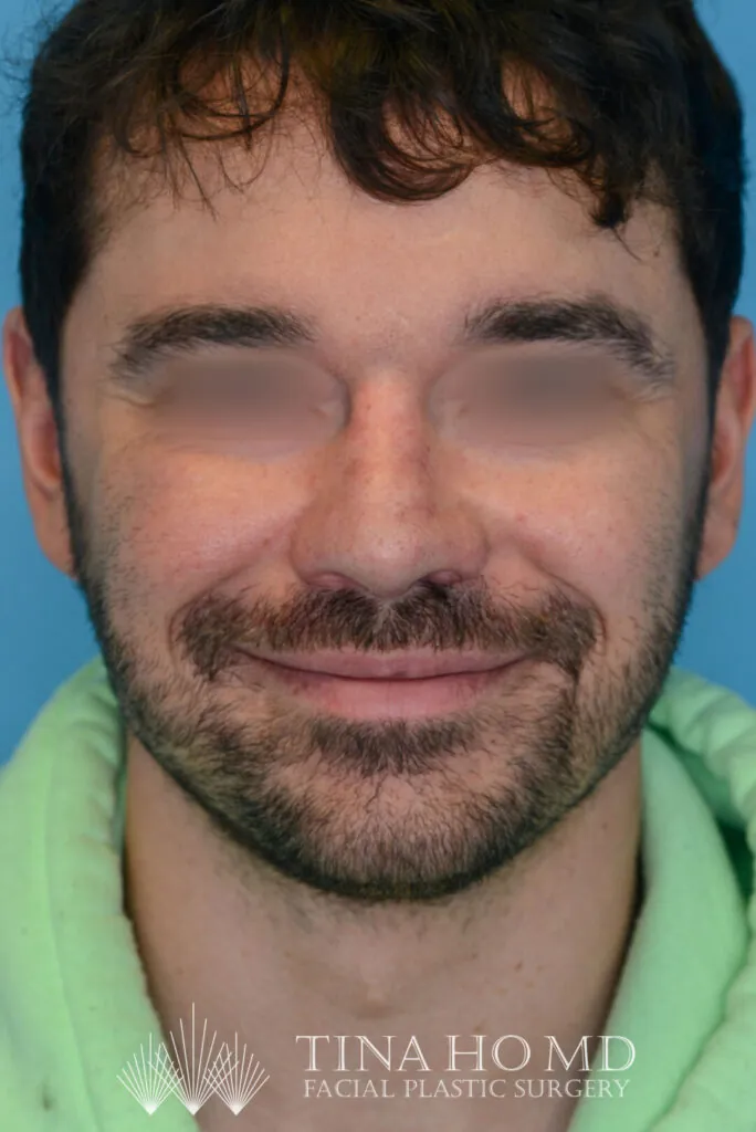 Patient DN's improved second frontal view after rhinoplasty
