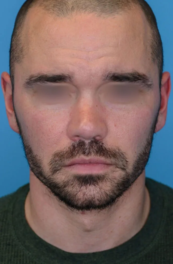 Patient DN's frontal view before rhinoplasty surgery