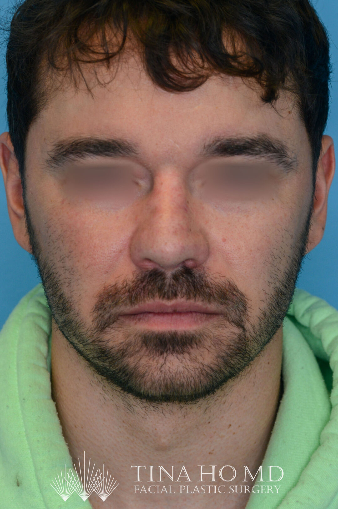 Patient DN's improved frontal view after rhinoplasty surgery