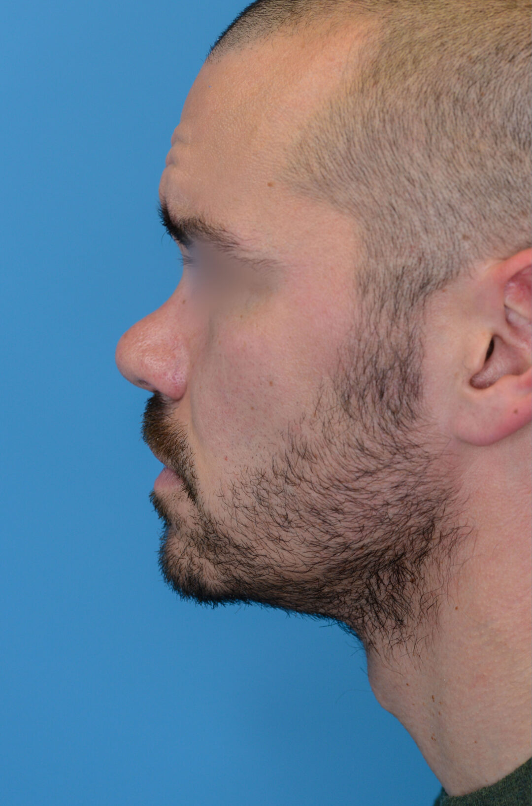 Patient DN's left lateral profile before rhinoplasty surgery