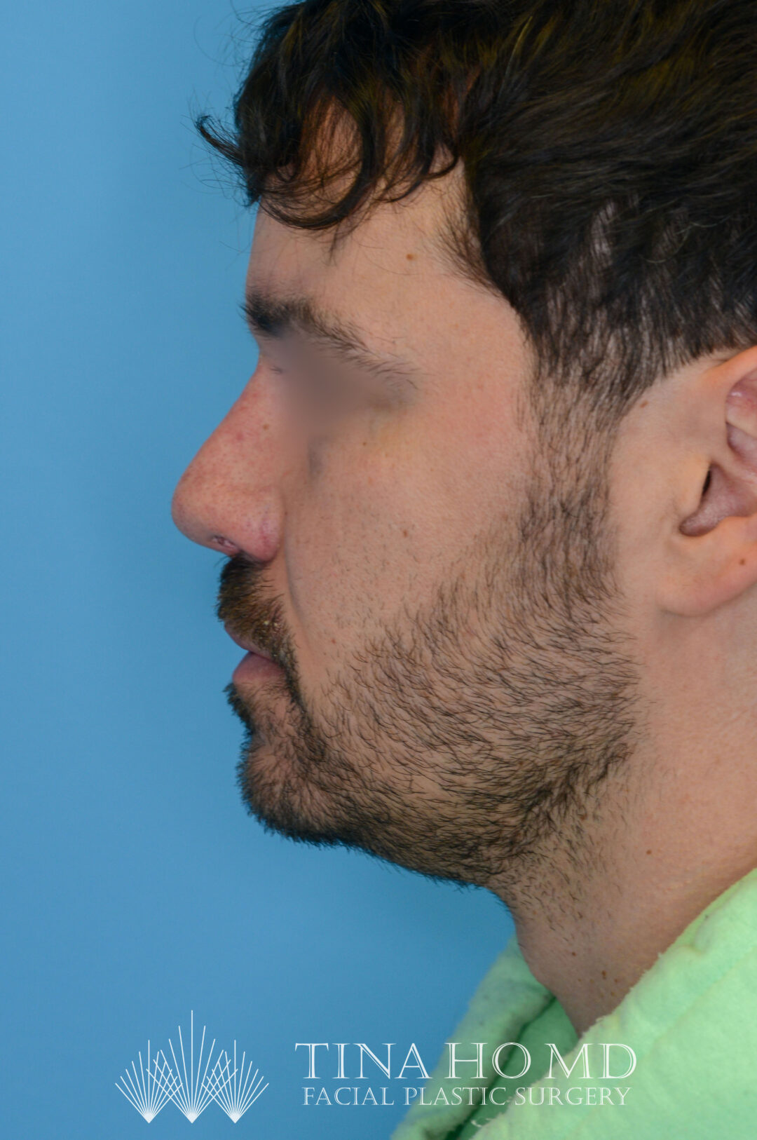 Patient DN's improved left lateral profile after rhinoplasty