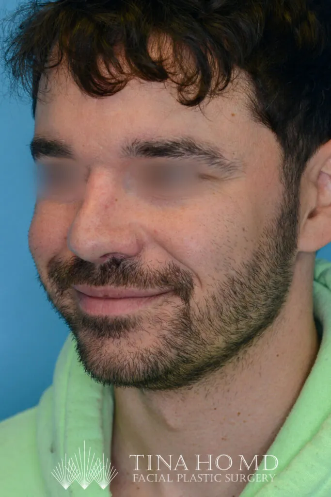 Patient DN's improved second left oblique view after rhinoplasty