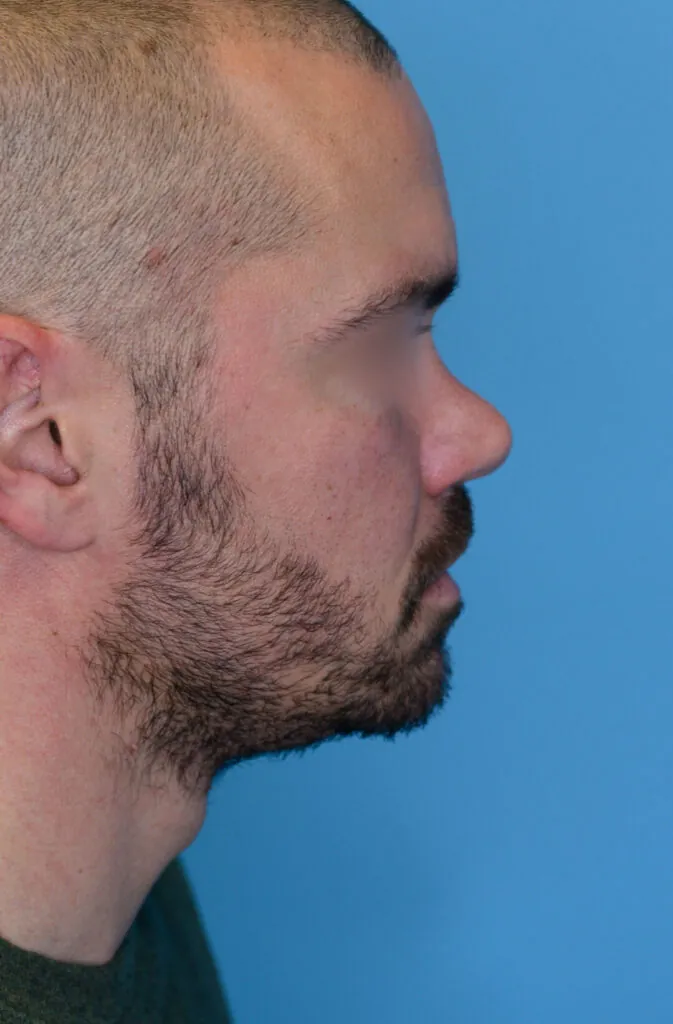 Patient DN's right lateral profile before rhinoplasty surgery