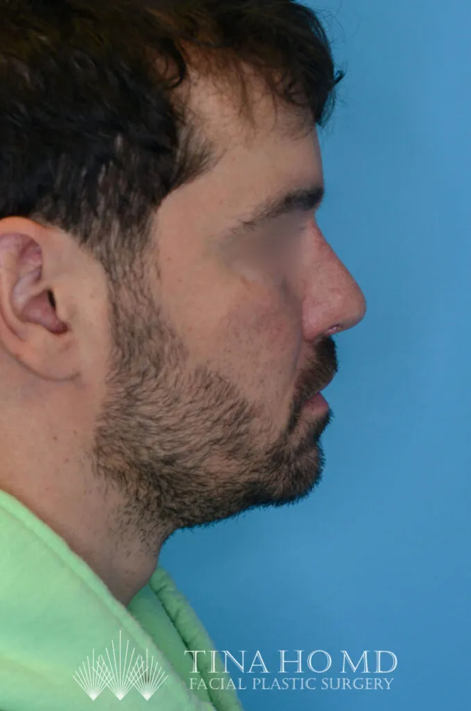 Patient DN's improved right lateral profile after rhinoplasty