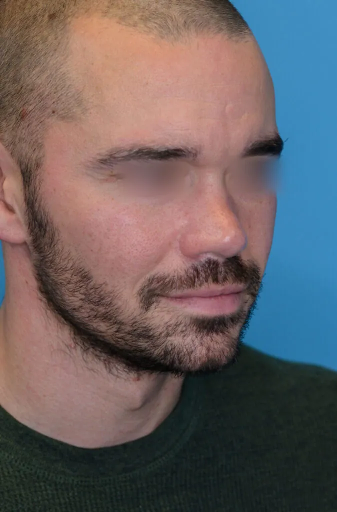 Patient DN's second right oblique view before rhinoplasty