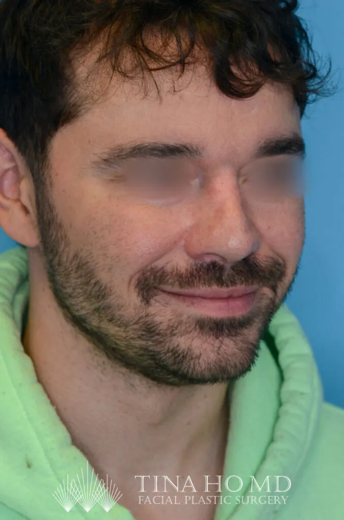 Patient DN's improved second right oblique view after rhinoplasty