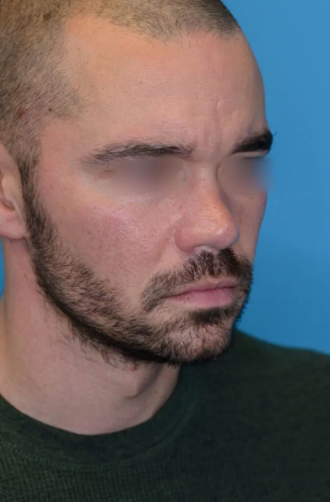 Patient DN's right oblique view before rhinoplasty surgery