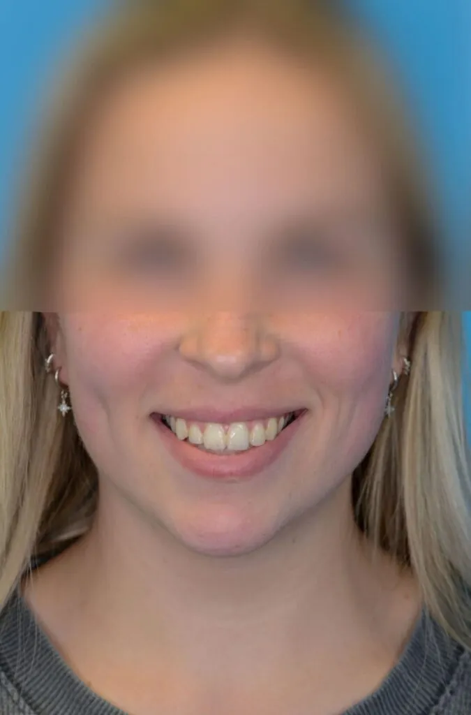 Person's frontal view before neck lift showing moderate submental fullness