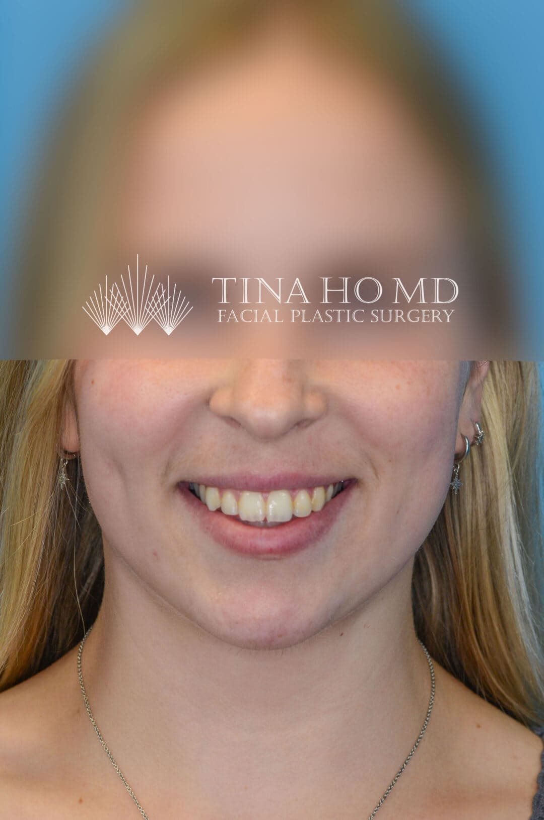 Person's frontal view after neck lift with reduced neck fullness and improved contour