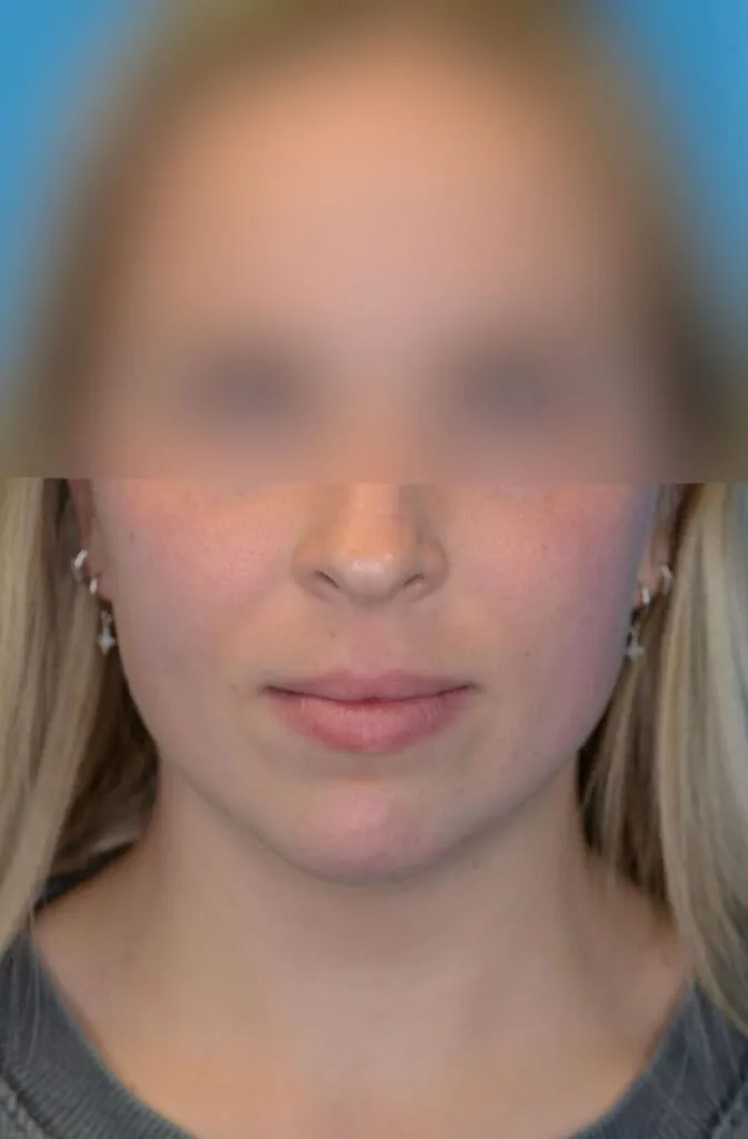 Person's frontal view before neck lift showing sagging skin on neck