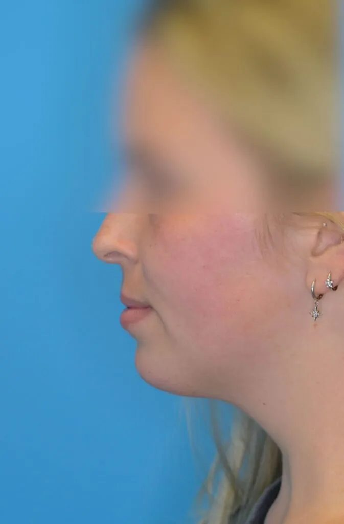 Person's left lateral profile before neck lift showing an undefined jawline