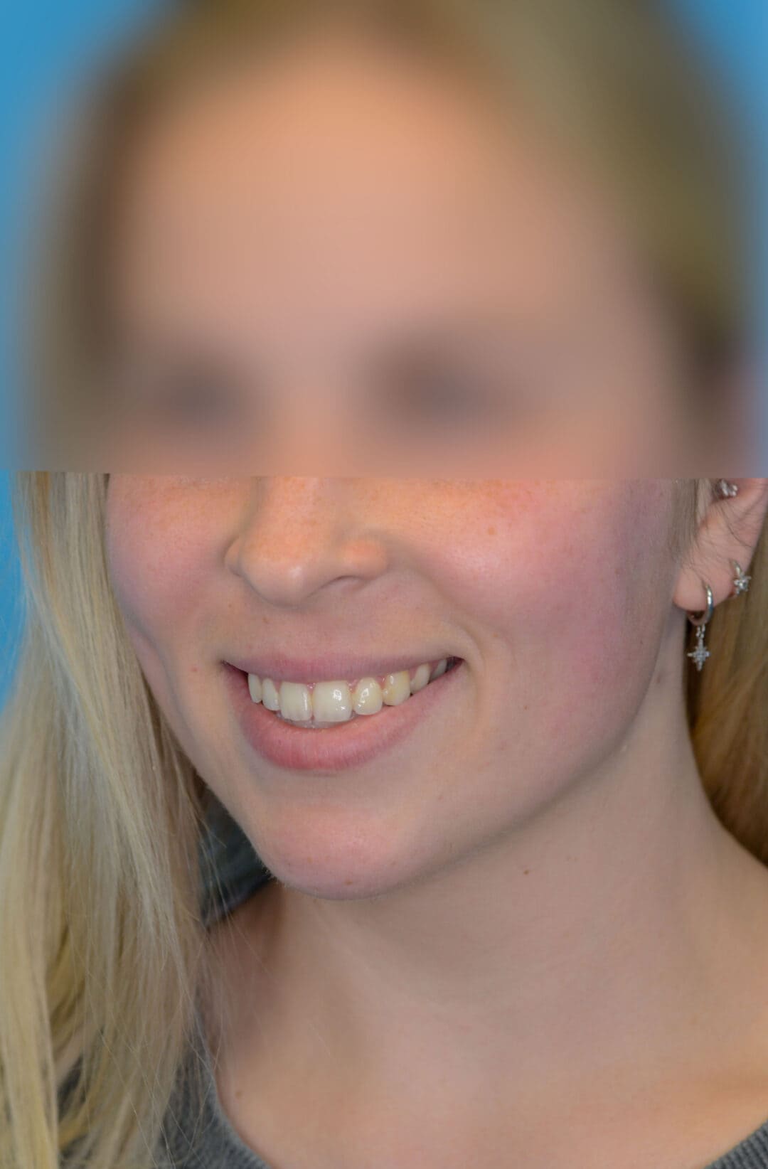 Person's left oblique view before neck lift showing noticeable neck laxity