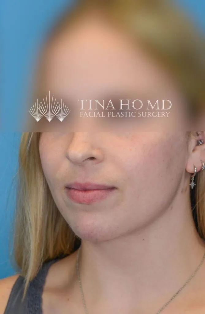 Person's left oblique view after neck lift with a smoother, tighter neck