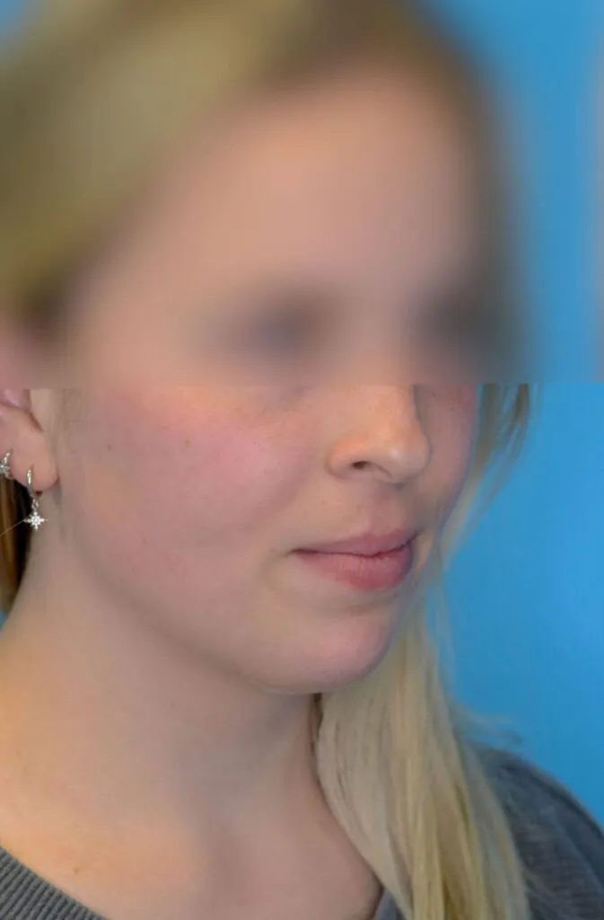 Person's right oblique view before neck lift showing loose skin and jowls