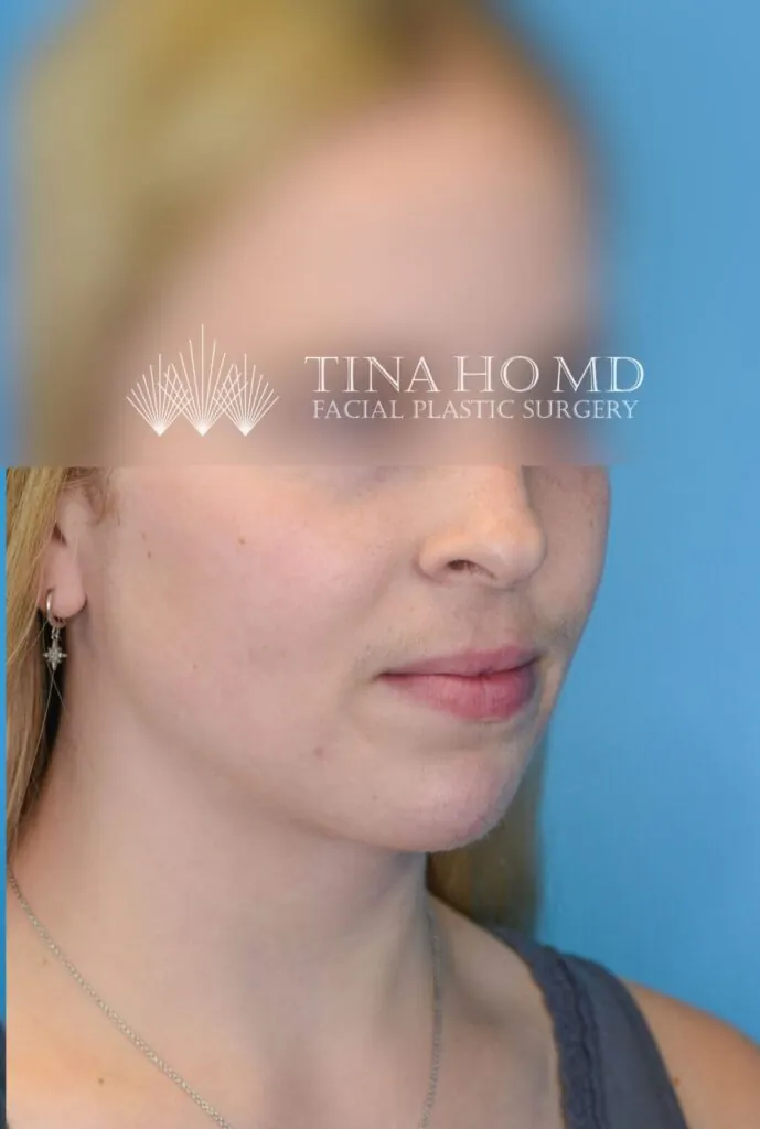 Person's right oblique view after neck lift with a tighter and smoother neck