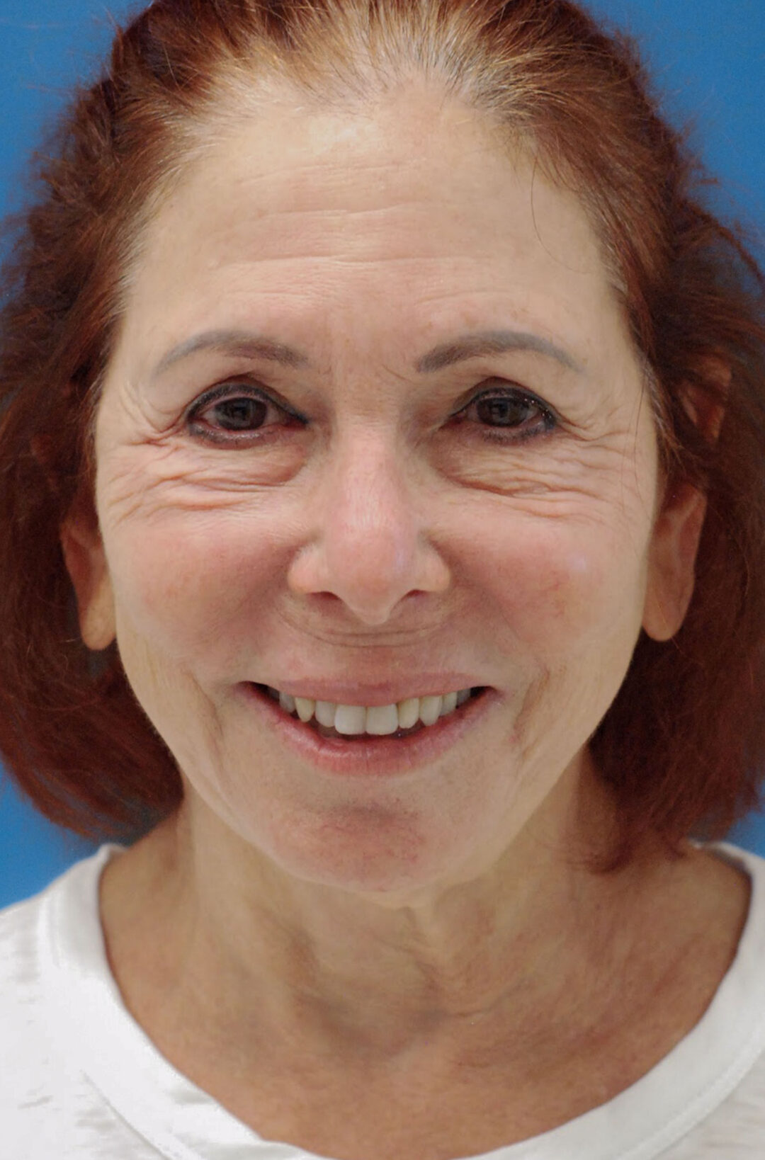 Patient's face, frontal view, before brow lift, upper blepharoplasty, neck lift, and facelift surgery in Philadelphia