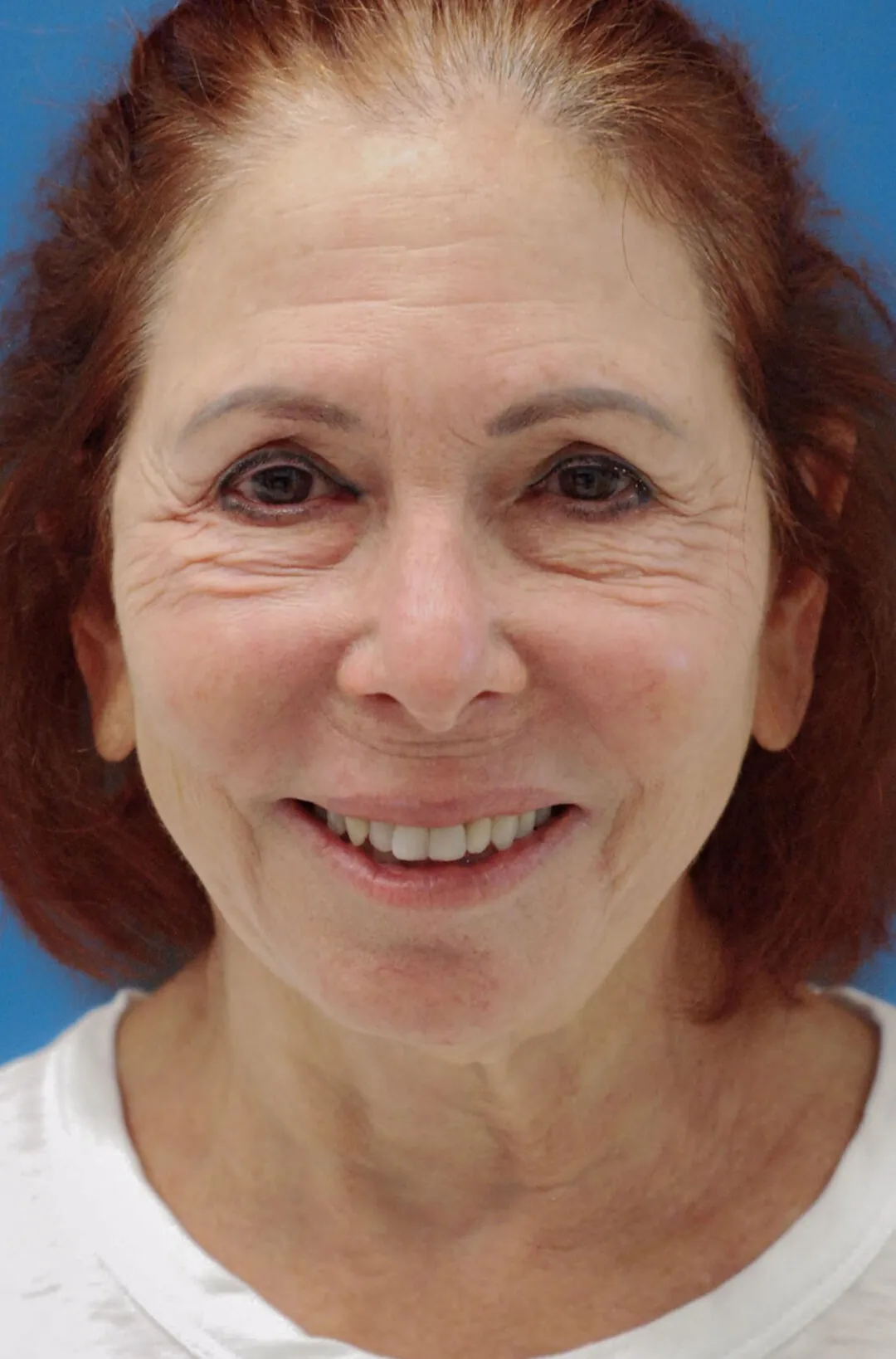Patient's face, frontal view, before brow lift, upper blepharoplasty, neck lift, and facelift surgery in Philadelphia