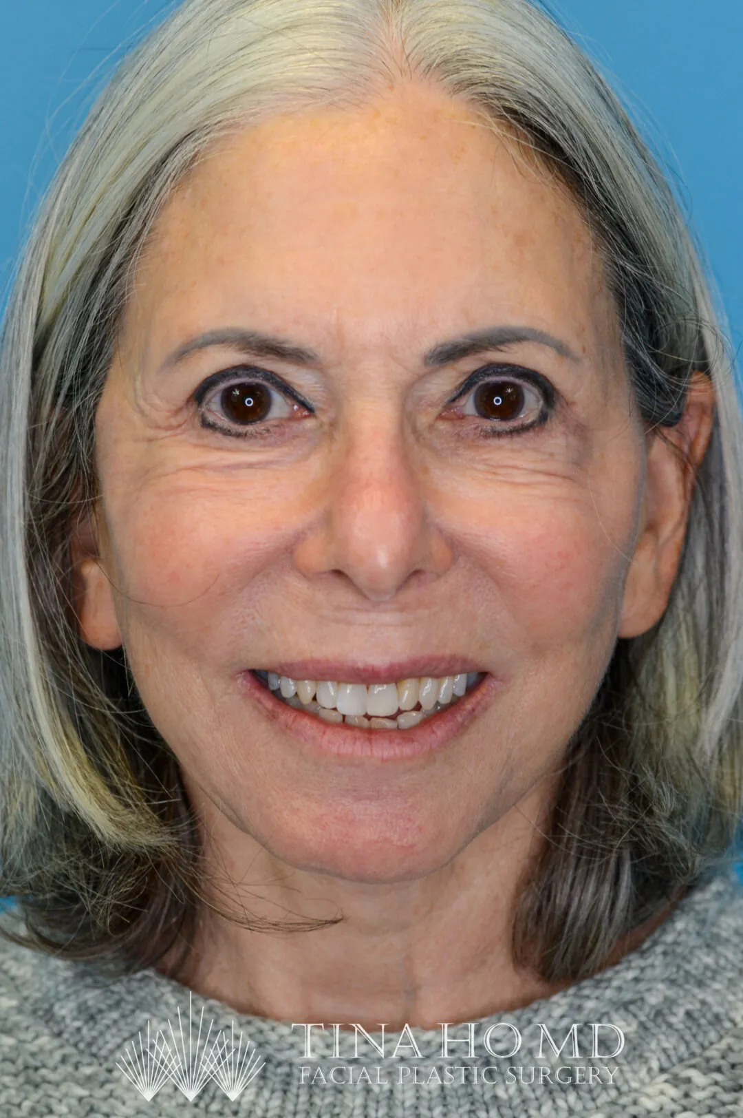 Patient's face, frontal view, after brow lift, upper blepharoplasty, neck lift, and facelift surgery in Philadelphia