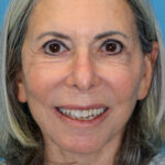 JMfacelift_frontal2(web) copy