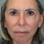 JMfacelift_frontal(web) copy