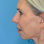 JMfacelift_leftlateral(web) copy