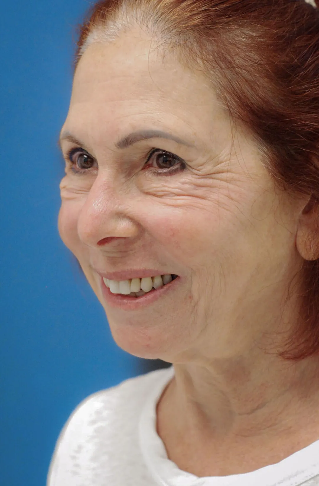 Patient JM left oblique view before upper blepharoplasty, face lift, and necklift surgery in Philadelphia