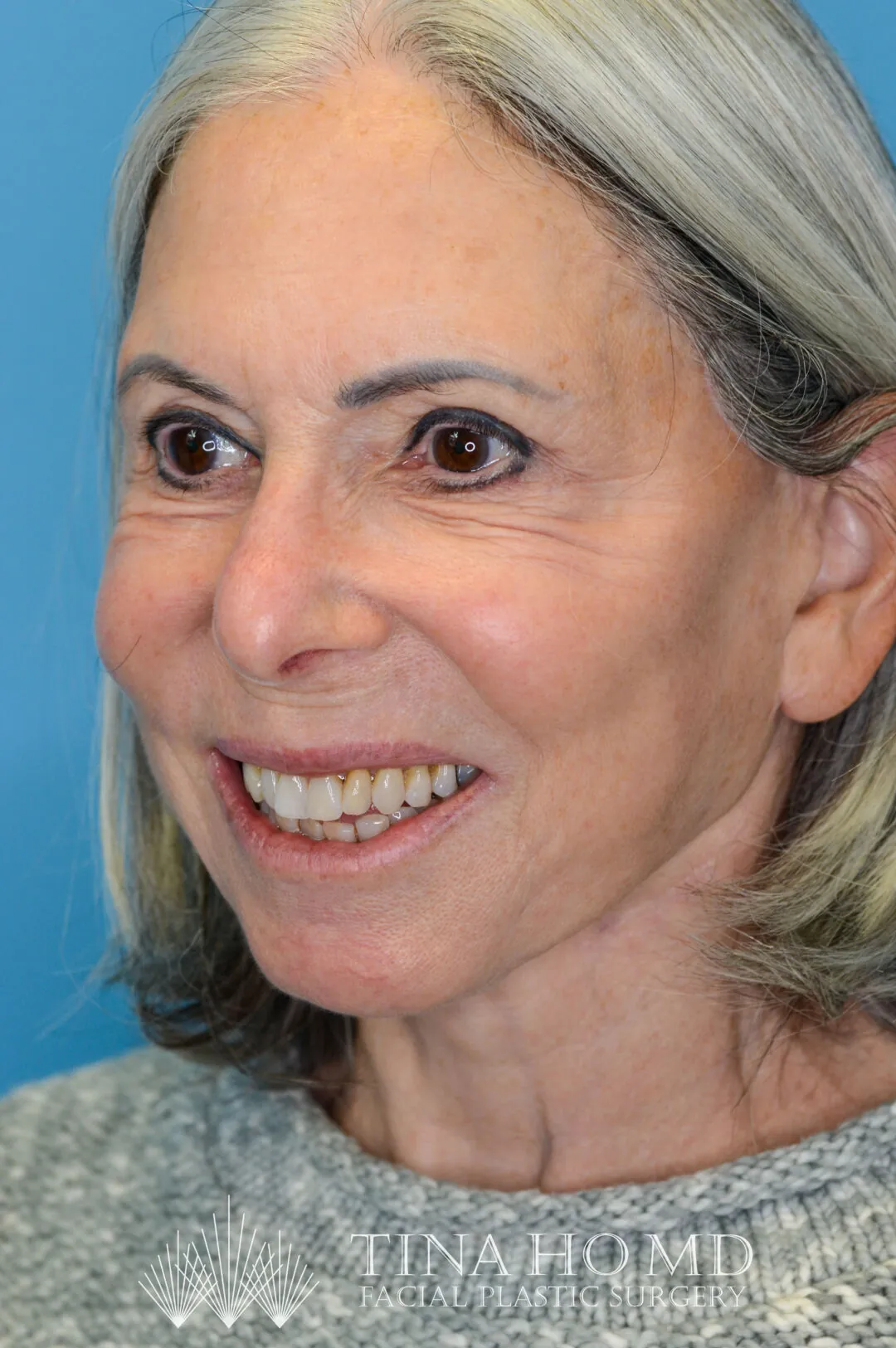 Patient JM left oblique view after upper blepharoplasty, face lift, and necklift surgery in Philadelphia