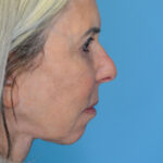 JMfacelift_rightlateral(web) copy