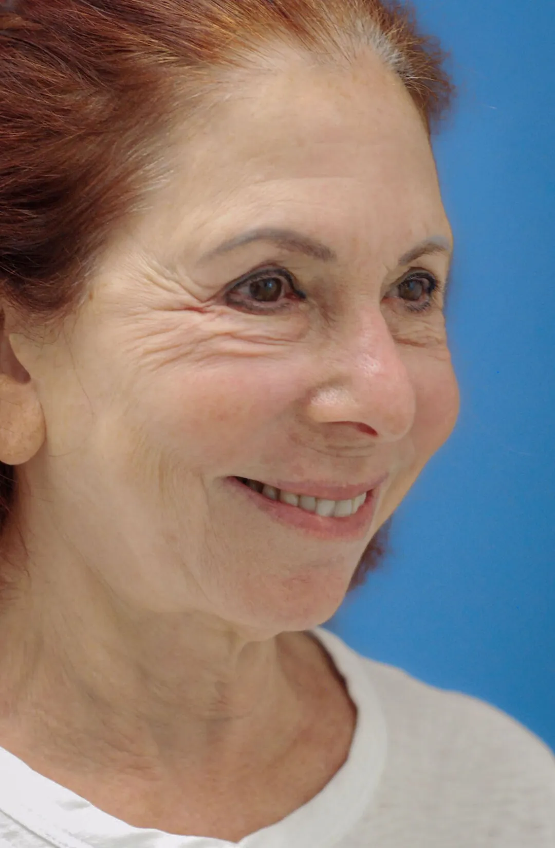 Patient JM right oblique view before upper blepharoplasty, facelift and neck lift in Philadelphia