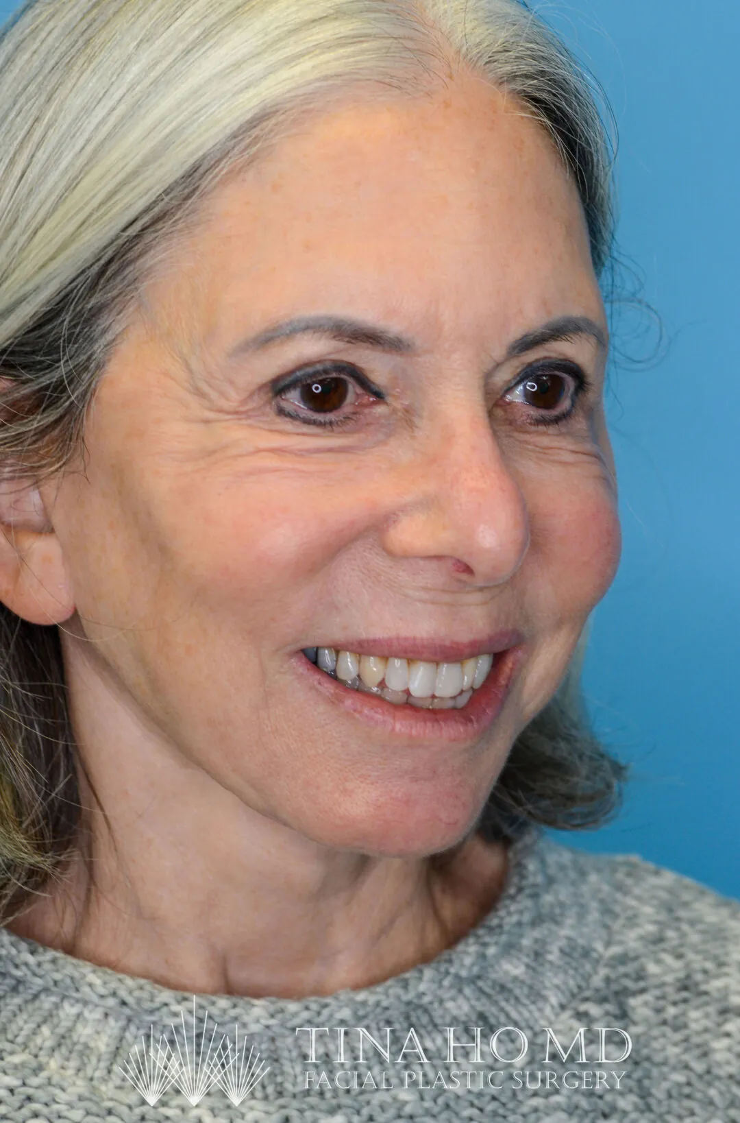 Patient JM right oblique view after upper blepharoplasty, facelift and neck lift in Philadelphia