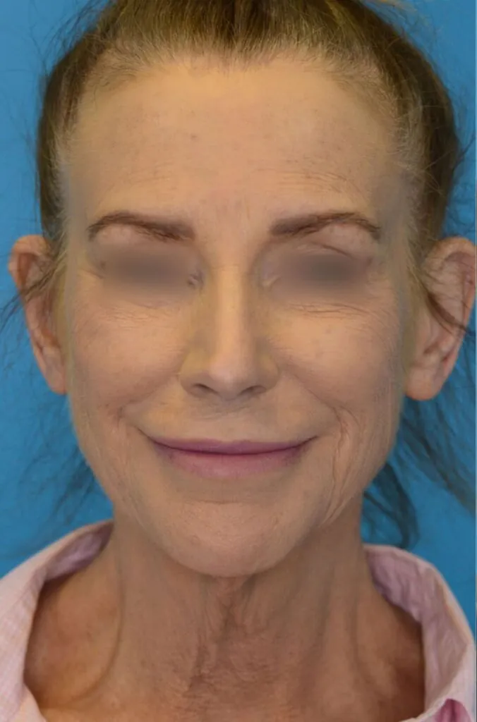 Person's frontal view before brow lift, facelift surgery and neck lift with visible submental fullness