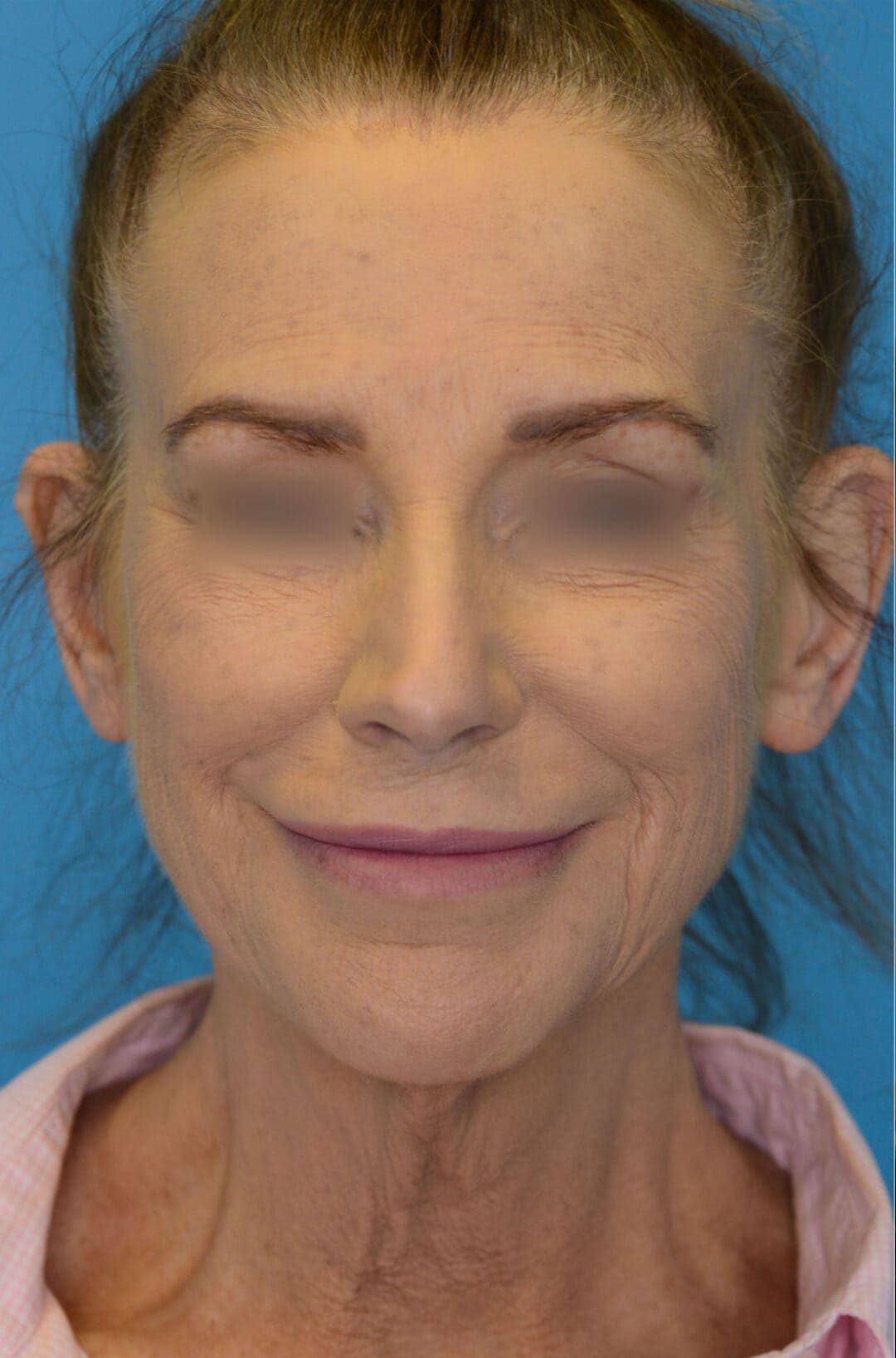 Person's frontal view before brow lift, facelift surgery and neck lift with visible submental fullness