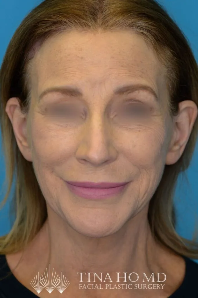Person's frontal view after brow lift, facelift surgery and neck lift with visible submental fullness