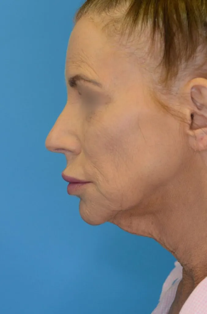 Patient's face, left lateral view, before facelift, brow lift and neck lift surgery