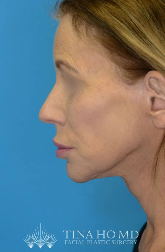 Patient's face, left lateral view, after facelift, brow lift and neck lift surgery
