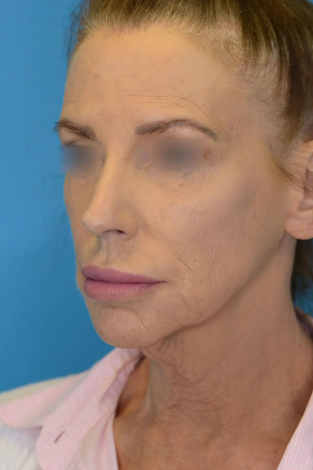 Patient's face, left oblique view, before brow lift, facelift, and neck lift surgery