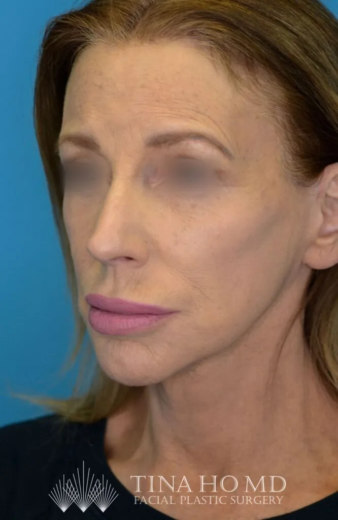 Patient's face, left oblique view, after brow lift, facelift, and neck lift surgery