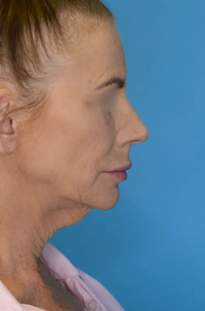 Patient's face, right lateral view, before brow lift, facelift, and neck lift surgery