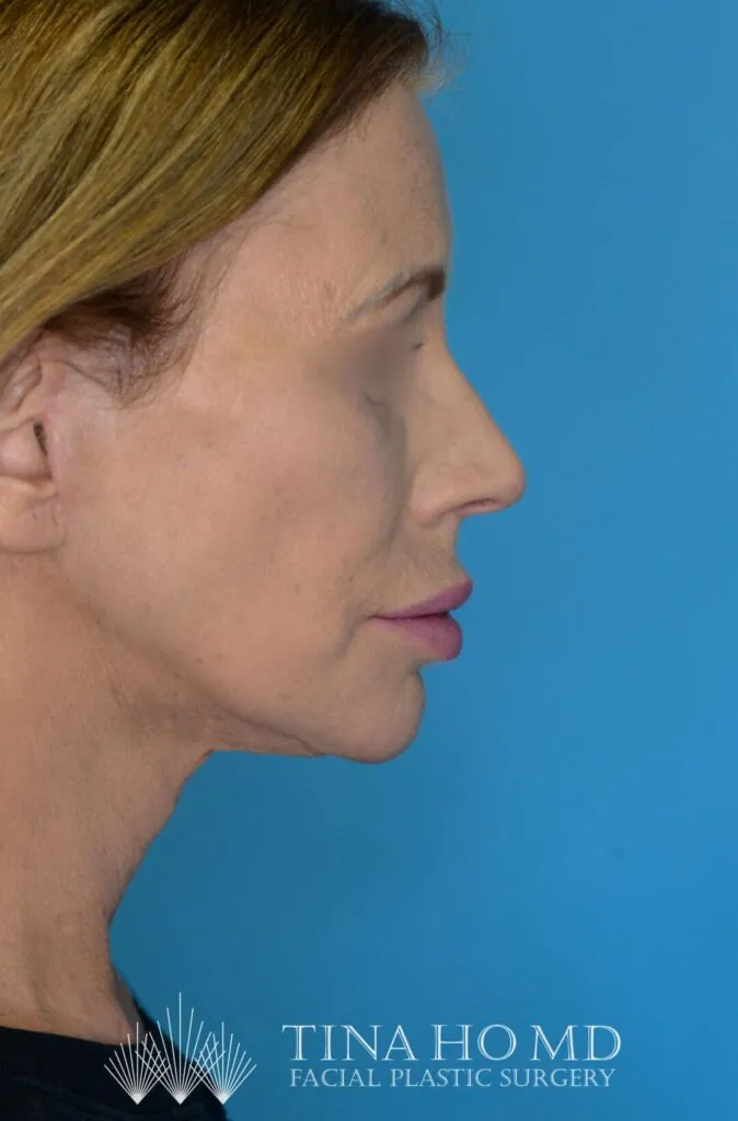 Patient's face, right lateral view, after brow lift, facelift, and neck lift surgery