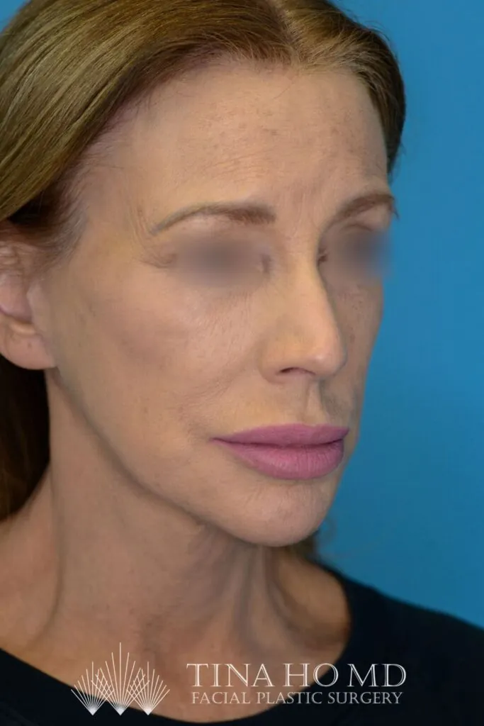 Patient's face, right oblique view, after brow lift, facelift, and neck lift surgery