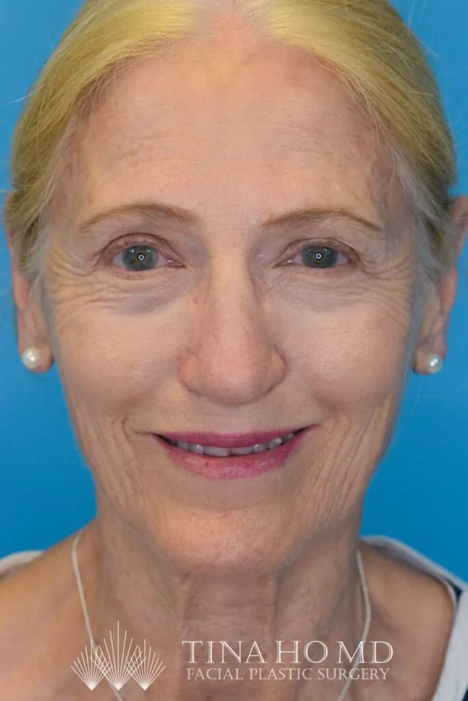 Patient NC's improved second frontal view after rhinoplasty