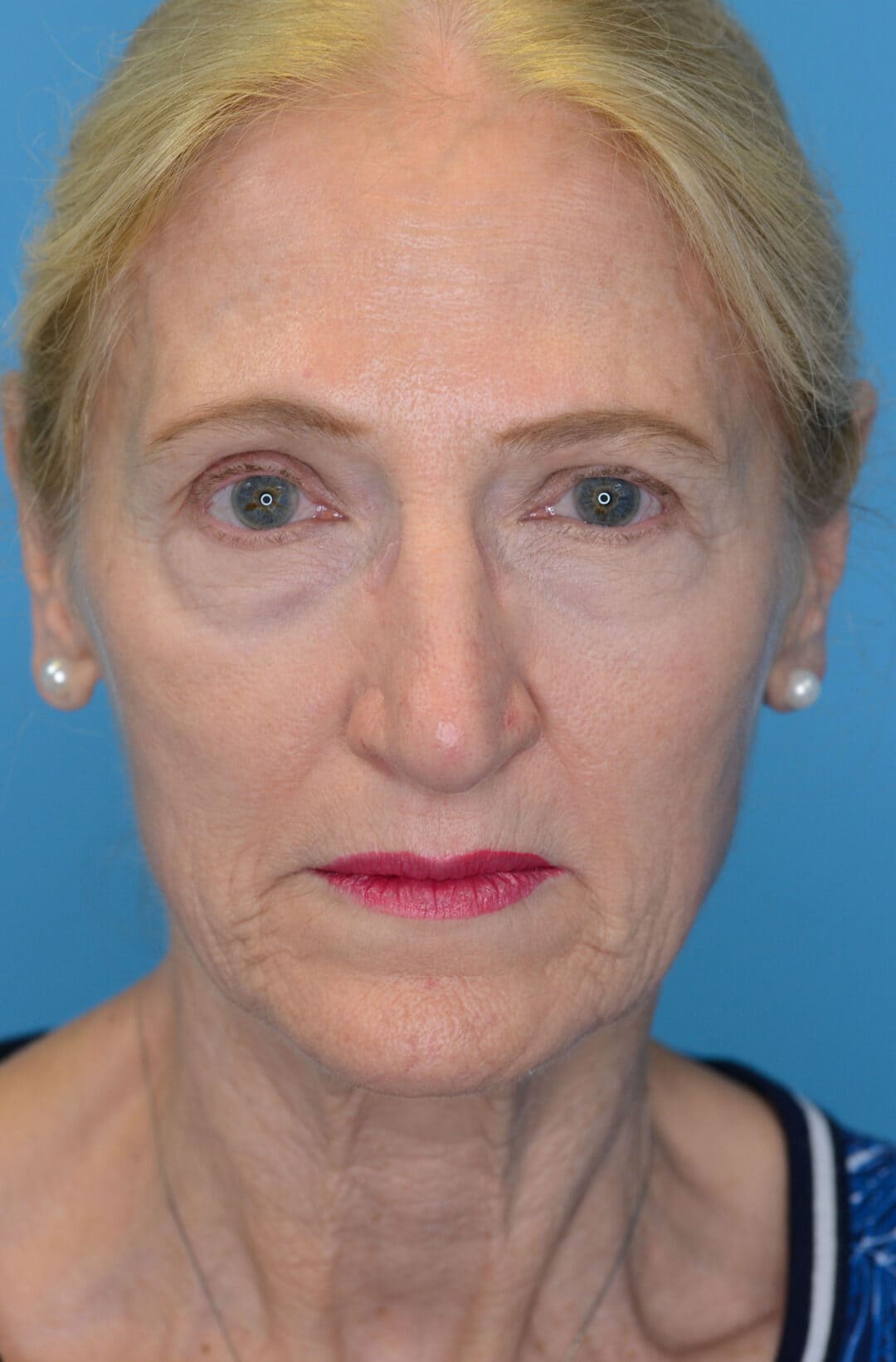 Patient NC's frontal view before rhinoplasty surgery