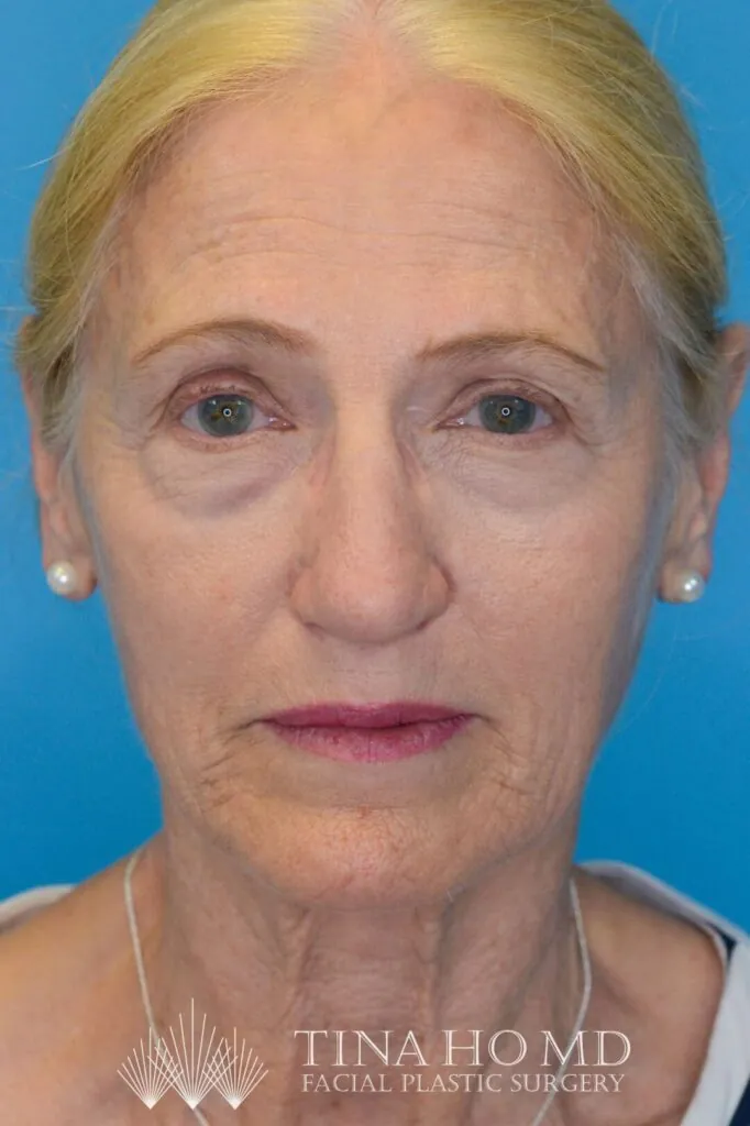 Patient NC's improved frontal view after rhinoplasty surgery